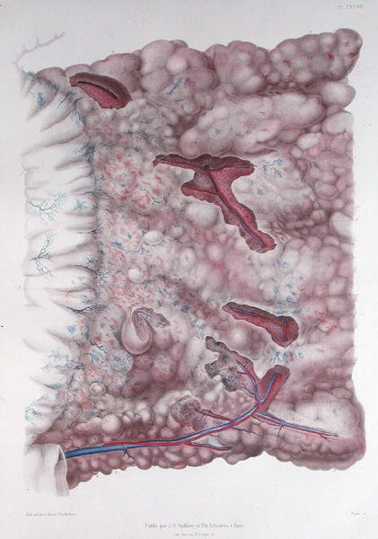 سرطان الإبيبلون ، من "Traite d'Anatomie Pathologique" بقلم هيرمان ليبرت (1813-1878) محفور بواسطة Oudet بواسطة (بعد) الرسامين