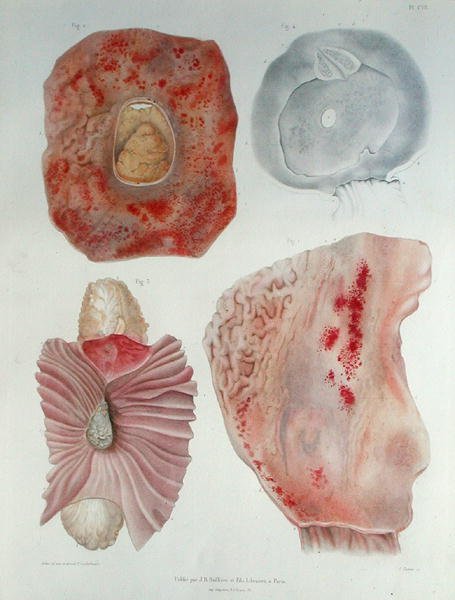 الأعضاء المصابة بالكوليرا ، من "Traite d'Anatomie Pathologique" بقلم هيرمان ليبرت (1813-1878) محفور بواسطة جيه توماس ، نُشر في باريس بواسطة (بعد) الرسامين