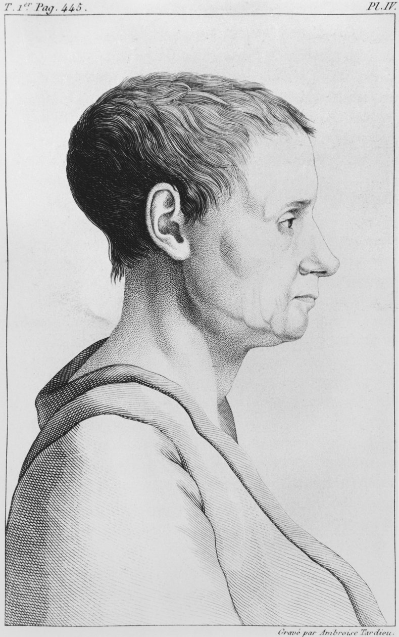 Theroigne de Mericourt ، التوضيح من "Des Maladies Mentales تعتبر dans le rapport medical، hygienique et medico-legal" بواسطة Etienne Esquirol (1772-1840) اللوحة الرابعة ، 1838 بواسطة أمبرواز تارديو
