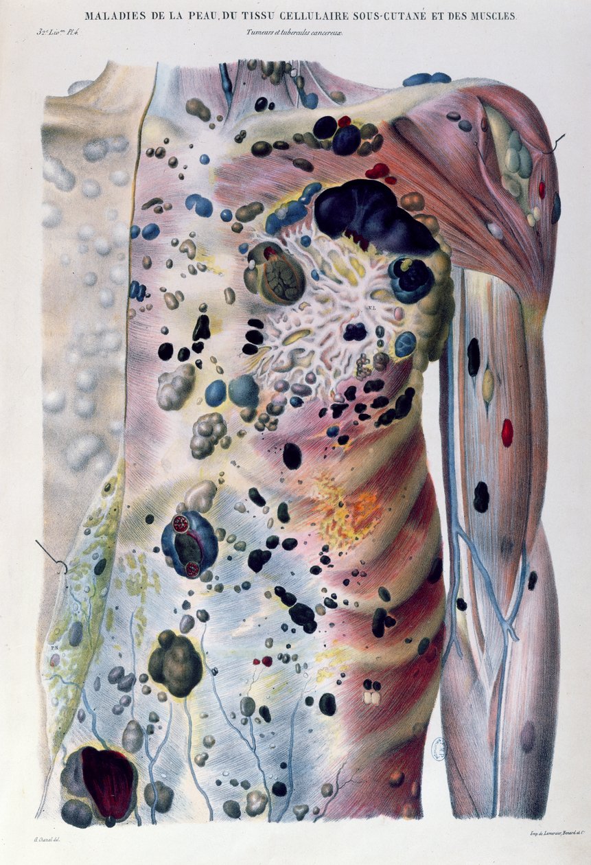 الأورام والدرنات السرطانية ، من "Anatomie Pathologique du Corps Humain" لجان كروفيلهاير (1791-1874) 1828-42 بواسطة انطوان شزال