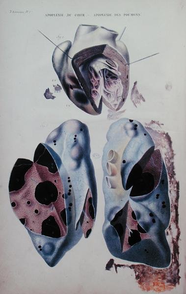 سكتة القلب والرئتين ، لوحة توضيحية من "Anatomie pathologique du corps humain" بقلم جان كروفيلهير (1791-1874) ، نُشرت في باريس بواسطة انطوان شزال