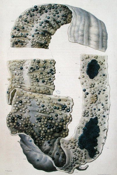 أمراض الأمعاء ، من "Anatomie Pathologique du Corps Humain" بقلم جان كروفيلهير (1791-1874) 1828-42 (نقش ملون) بواسطة انطوان شزال