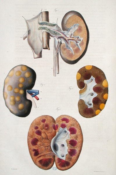 أمراض الكلى ، من "Anatomie Pathologique du Corps Humain" بقلم جان كروفيلهير (1791-1874) 1828-42 (نقش ملون) بواسطة انطوان شزال