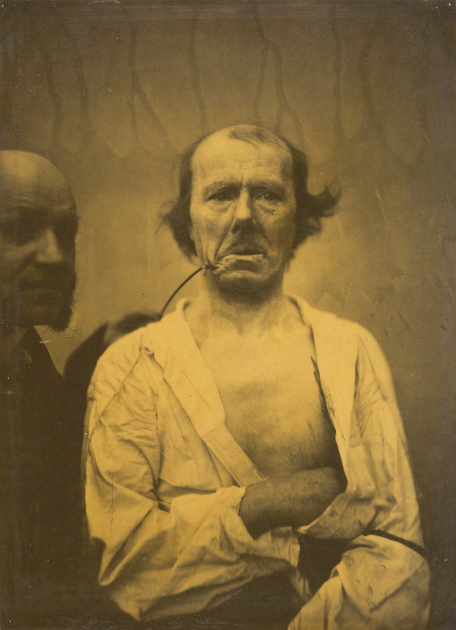 تعبير مريح يسار ، يمين الاشمئزاز ، 1854-1856 ، مطبوع عام 1862. بواسطة دوشين دي بولوني