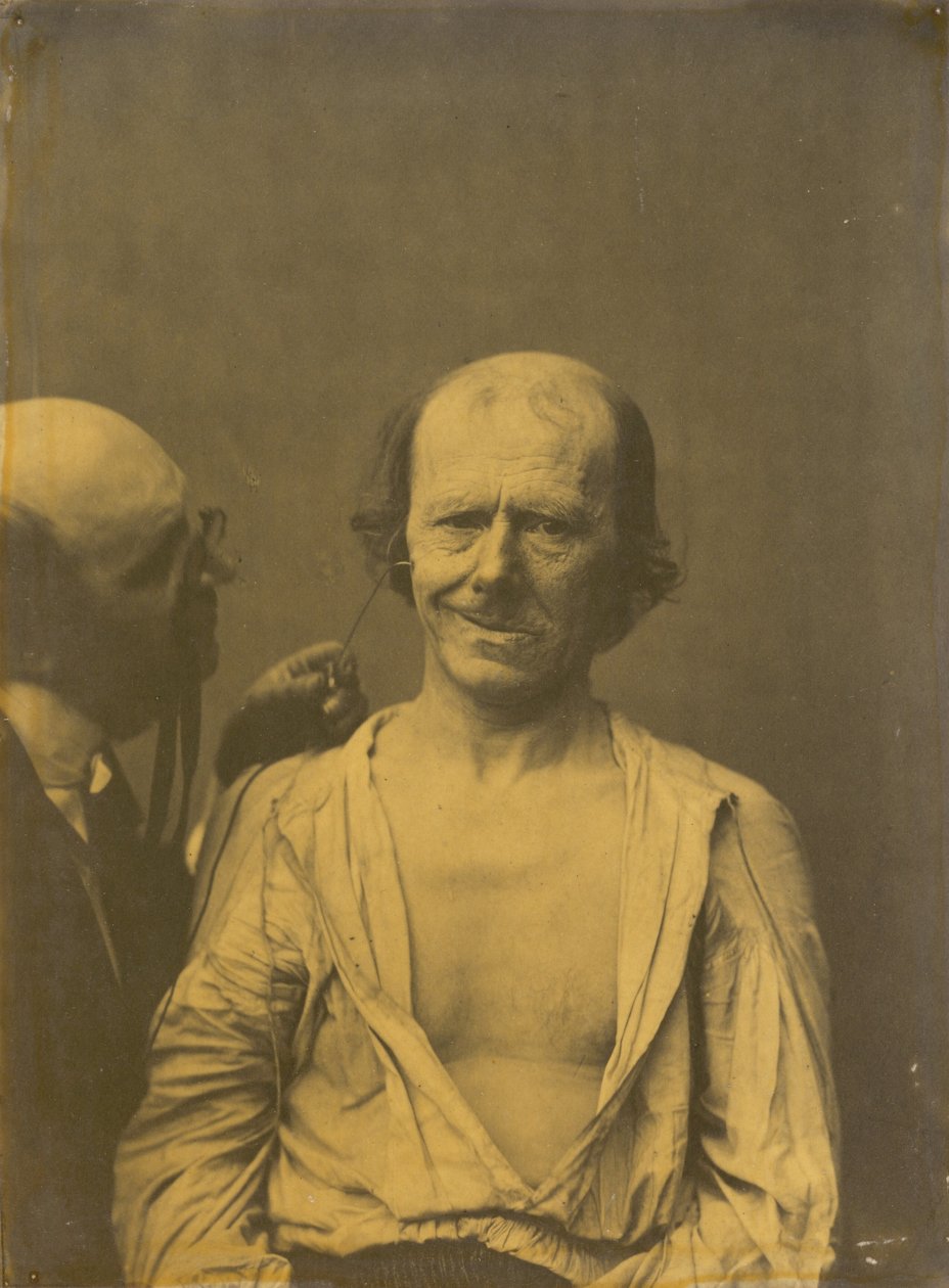 وجه مسترخي يسار ، فرح كاذب أو ضحك يمينًا ، 1854-1856 ، مطبوع عام 1862. بواسطة دوشين دي بولوني