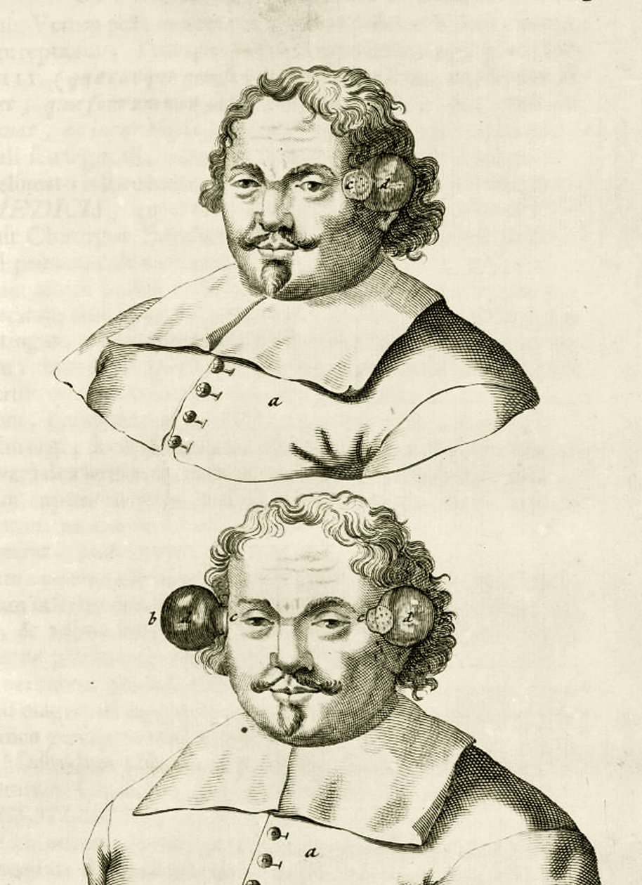 مثال على الحجامة ، من التمارين العملية إلى طريقة العلاج بواسطة فريدريك ديكرز ، 1694 بواسطة المدرسة الهولندية