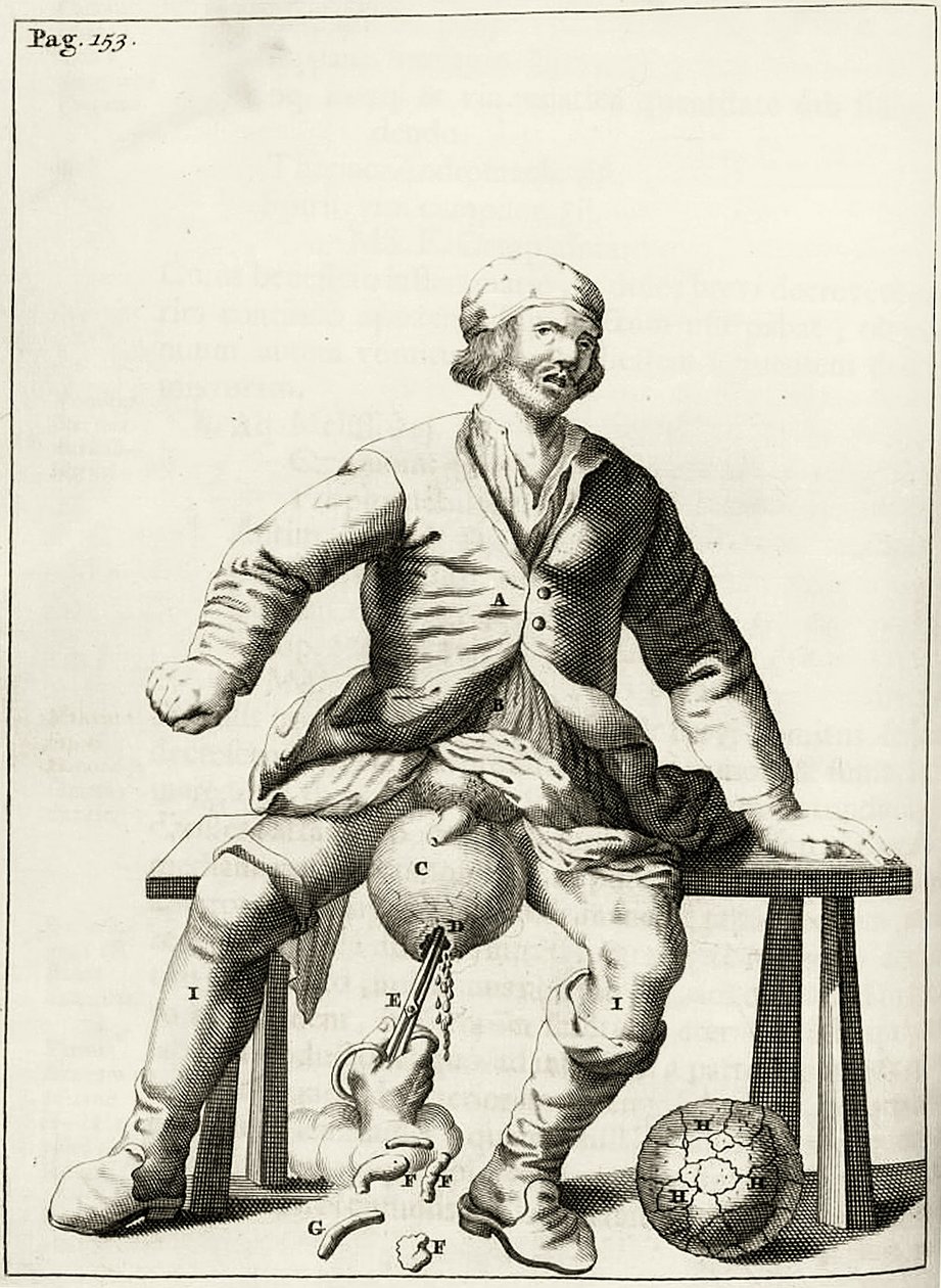 تصريف السوائل من القيلة الصفنية ، من التمارين العملية لعلاج الطريقة بواسطة فريدريك ديكرز ، 1694 بواسطة المدرسة الهولندية