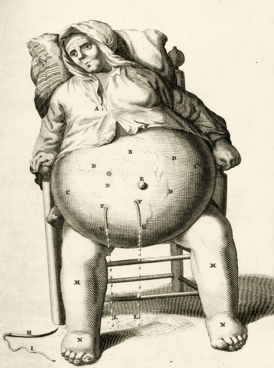 تصريف السوائل من الخراج ، من التمارين العملية إلى طريقة الشفاء بواسطة فريدريك ديكرز ، 1694 بواسطة المدرسة الهولندية
