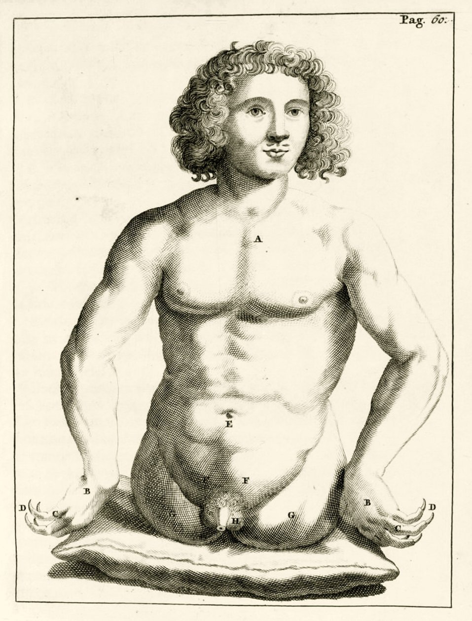 مثال على العيوب الخلقية ، من التمارين العملية إلى طريقة العلاج بواسطة فريدريك ديكرز ، 1694 بواسطة المدرسة الهولندية