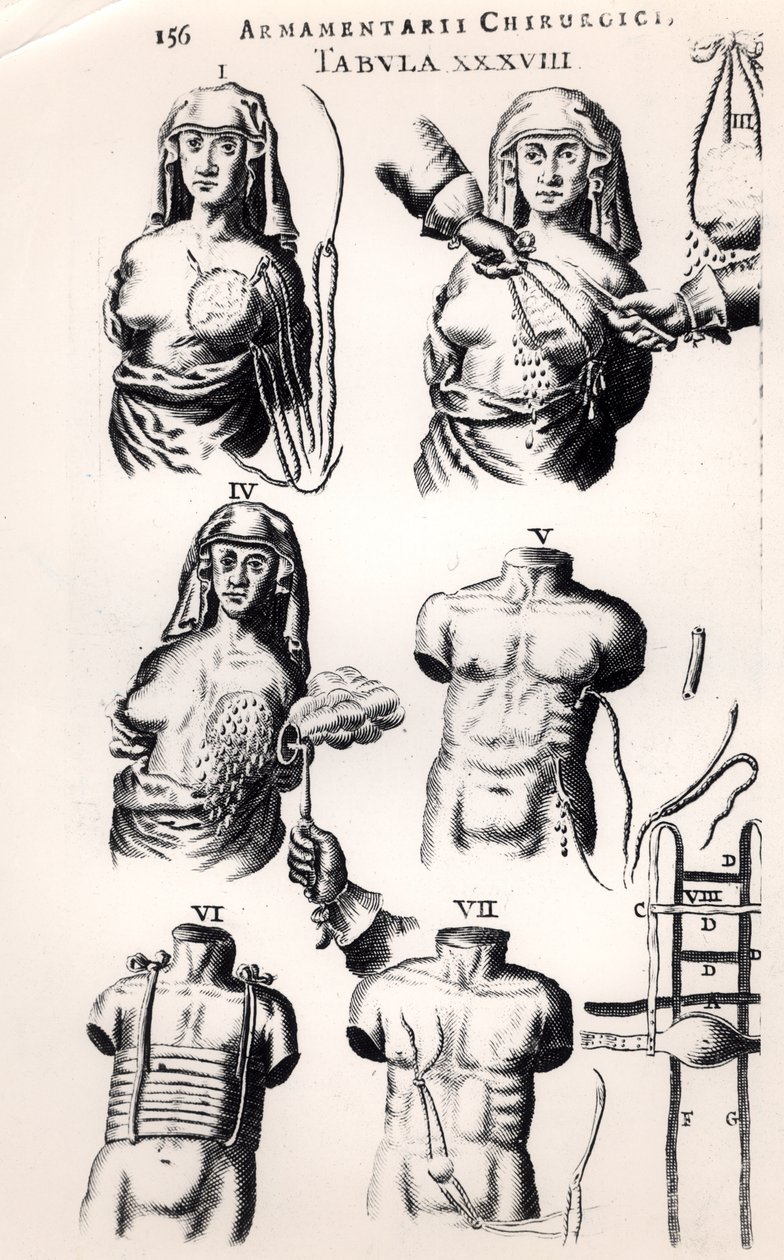 العمل على سرطان الثدي ، من Armamentarii Chirurgici بقلم يوهانس شولتس (1595-1645) المنشور في أمستردام ، 1672 بواسطة المدرسة الهولندية