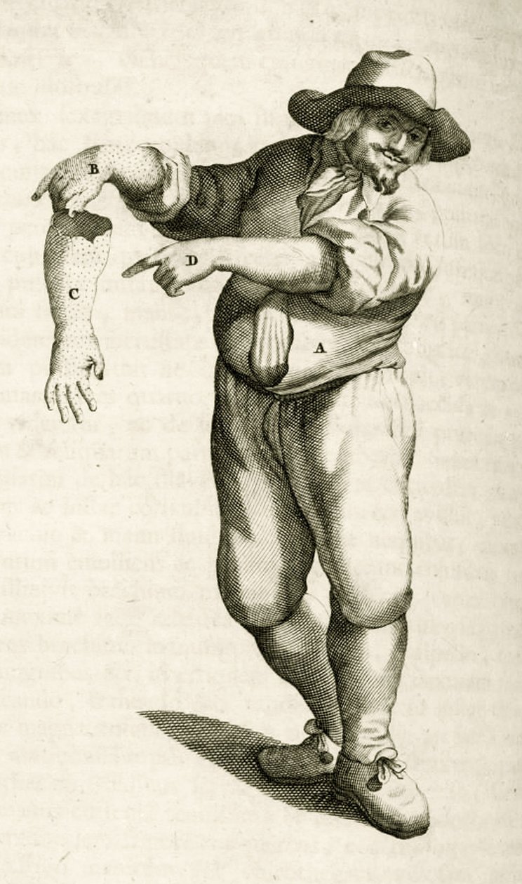إزالة الجلد الميت بالبثرات ، من التمارين العملية لعلاج الطريقة بواسطة فريدريك ديكرز ، 1694 بواسطة المدرسة الهولندية