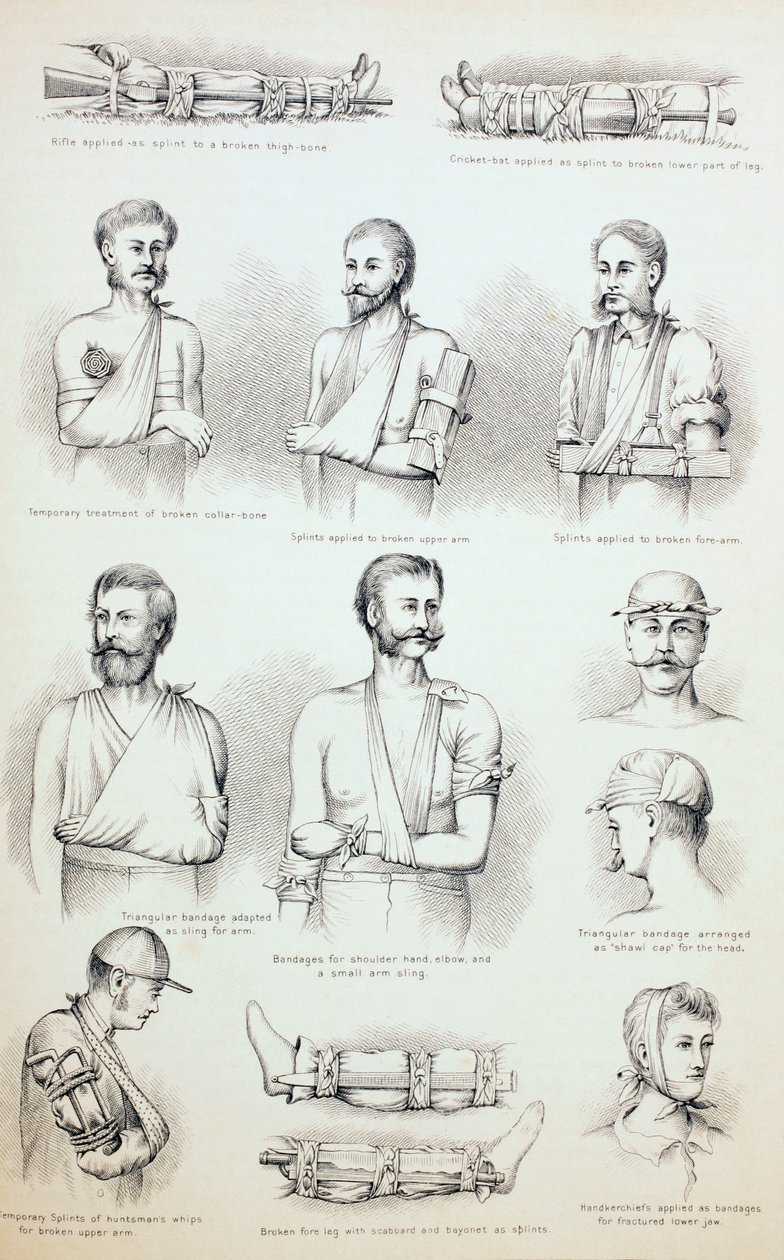العلاج المؤقت للكسور ، c.1890 بواسطة مدرسة اللغة الإنجليزية