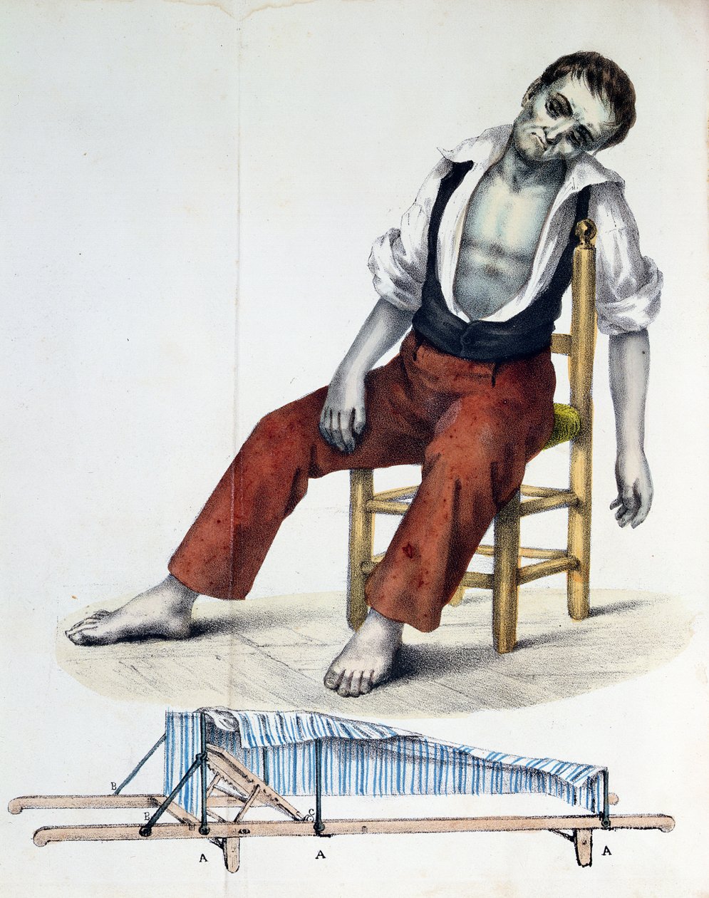 الكوليرا موربوس ، من Relação ، Historica ، Statistica e Medica da Cholera-Morbus بواسطة Francisco dAssis de Souza Vaz ، 1833 بواسطة المدرسة الفرنسية