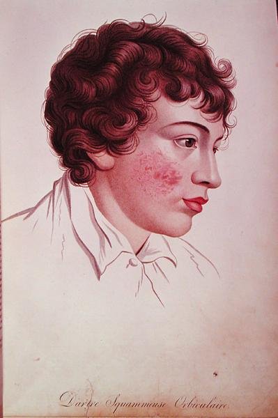 رقعة جافة من 'Description des Maladies de la Peau' للبارون جان لويس أليبرت (1768-1837) بواسطة المدرسة الفرنسية