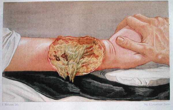 مستشفى الغرغرينا ، من "Traite de Chirurgie de Guerre" ، بقلم إدموند ديلورم (1847-1929) نقش بواسطة F. Meheux بواسطة المدرسة الفرنسية