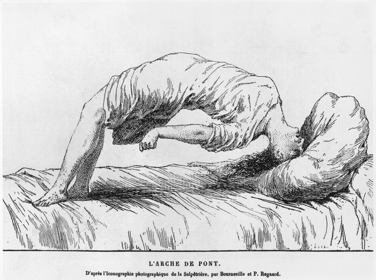 الهستيريا والسفول ، من Les Maladies Epidemiques de lEsprit بواسطة Paul Regnard (1850-1927) 1884 بواسطة المدرسة الفرنسية