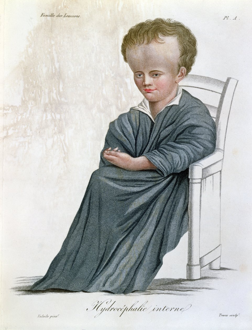 استسقاء داخلي ، من Nosologie Naturelle بواسطة البارون جان لويس عليبرت (1768-1837) منقوش بواسطة Tresca ، 1817 بواسطة المدرسة الفرنسية