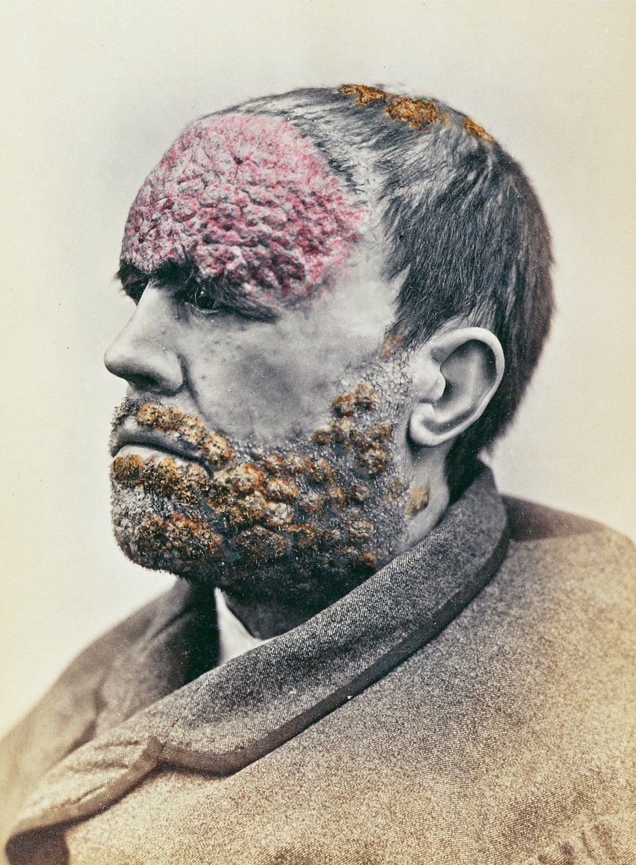 رجل يعاني من مرض الزهري ، من صورة تم التقاطها لصالح Clinique Photographique de lHopital Saint-Louis ، 1868 بواسطة المدرسة الفرنسية