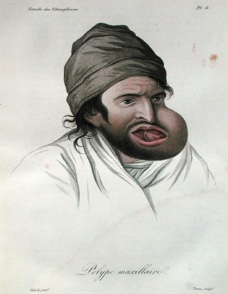 ورم الفك العلوي ، من كتاب للبارون جان لويس أليبرت (1768-1837) 1817 (نقش ملون) بواسطة المدرسة الفرنسية
