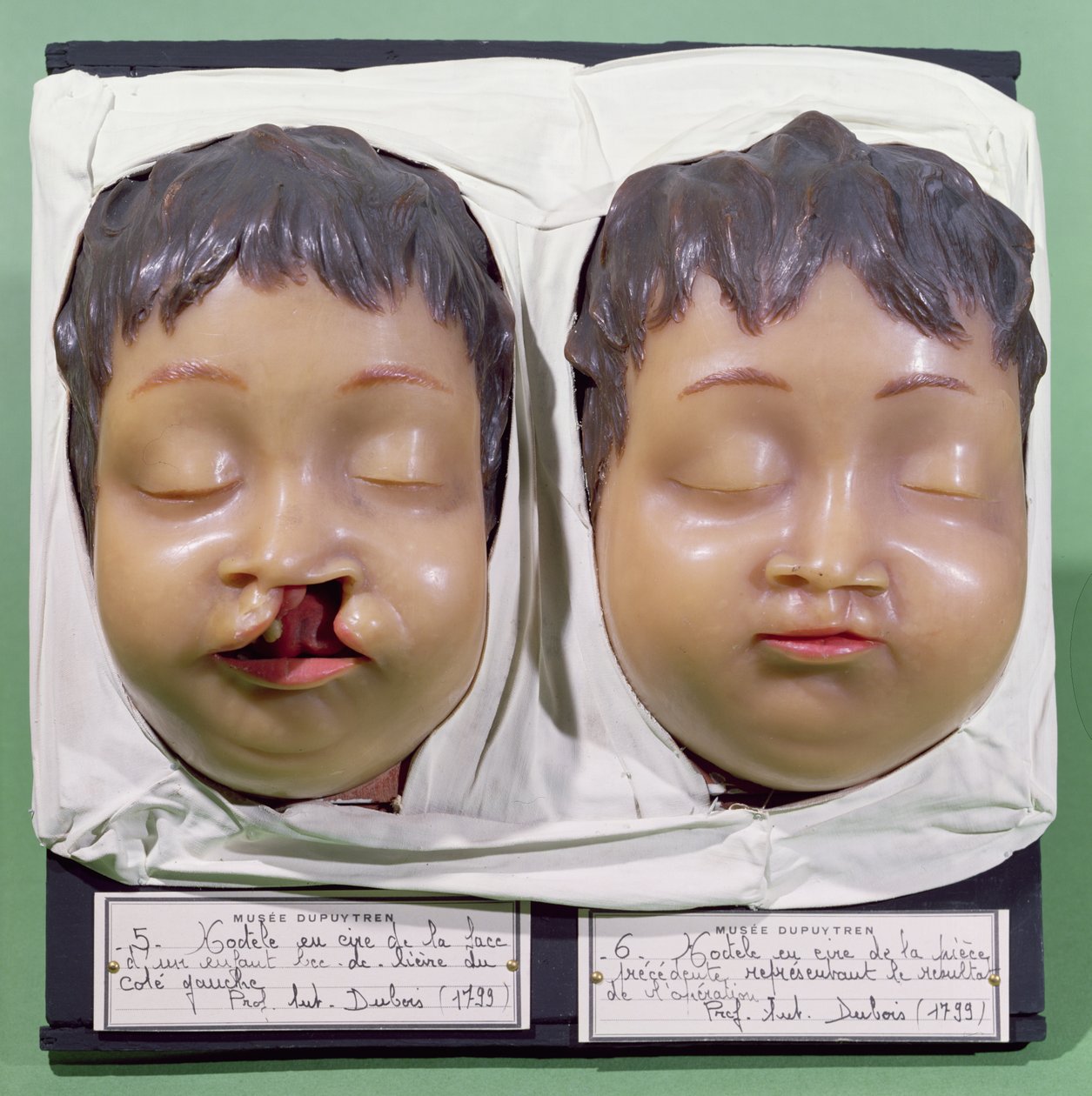 نموذج يظهر وجه طفل قبل وبعد عملية لتصحيح آفة شعرية قام بها أنطوان دوبوا (1756-1837) عام 1799 (شمع) بواسطة المدرسة الفرنسية