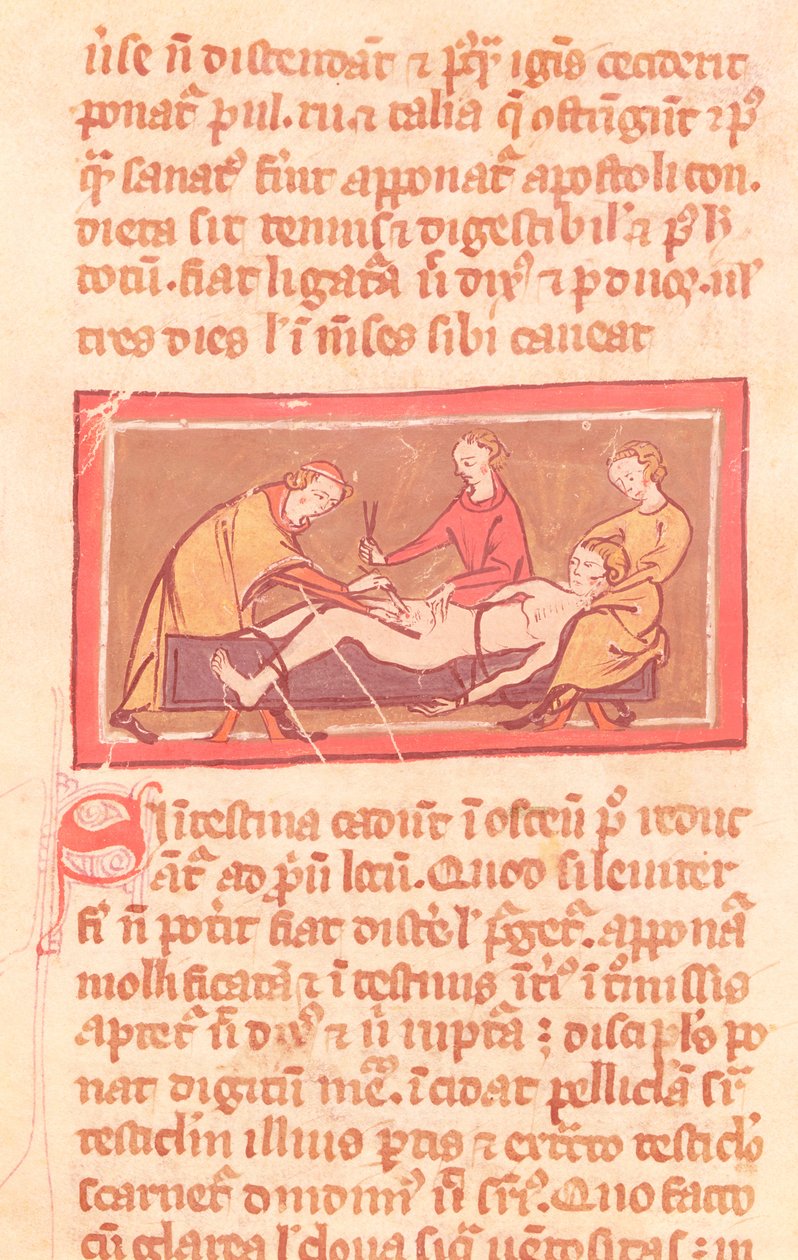 السيدة H 89 fol.23 الجراحة ، من طبعة من كتاب الجراحة بقلم روجير دي ساليرن بواسطة المدرسة الفرنسية