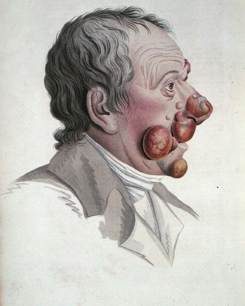 Mycosis Fongoide ، من كتاب للبارون جان لويس أليبرت (1768-1837) 1838 (نقش ملون) بواسطة المدرسة الفرنسية