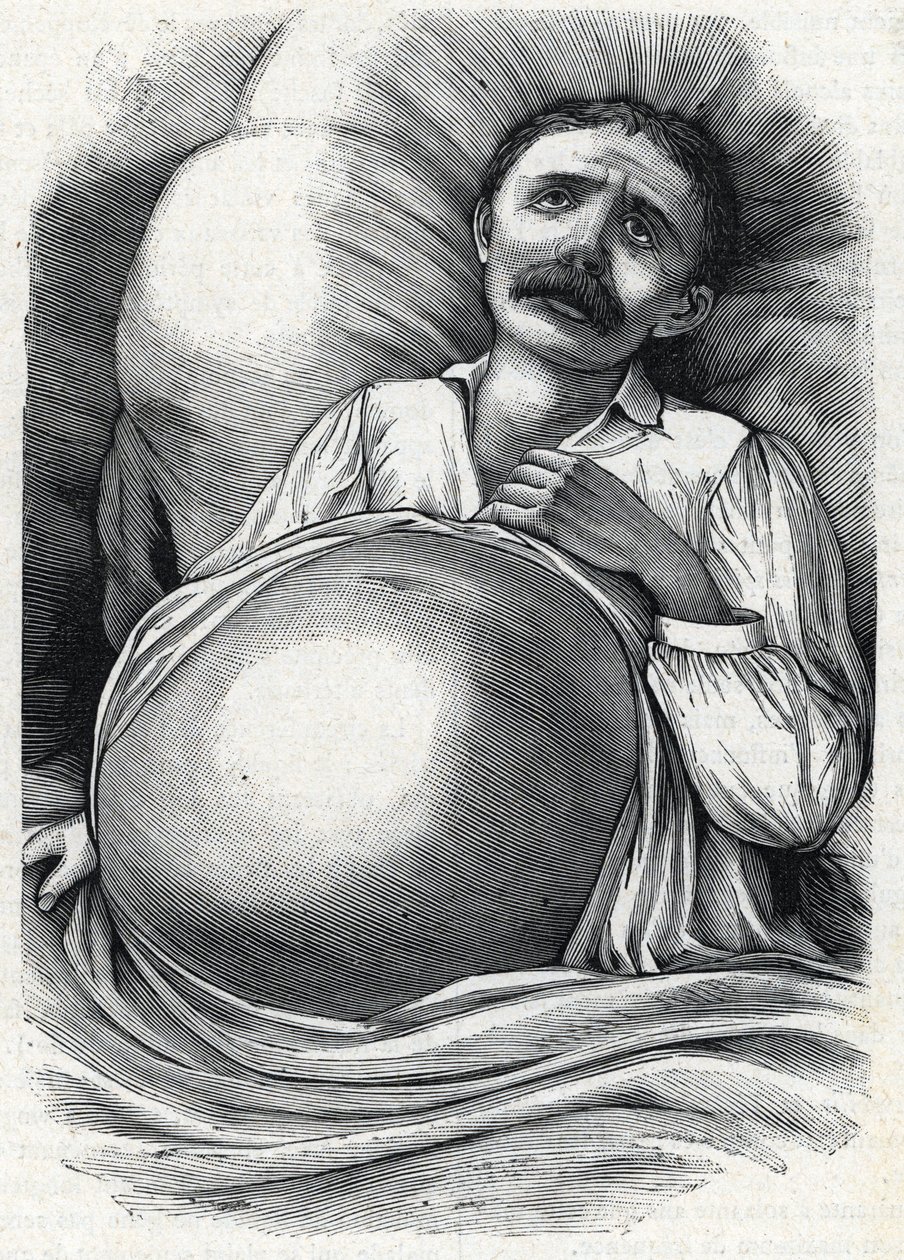 مريض بتليف كبدي متقدم (نقش) 1888 بواسطة المدرسة الفرنسية