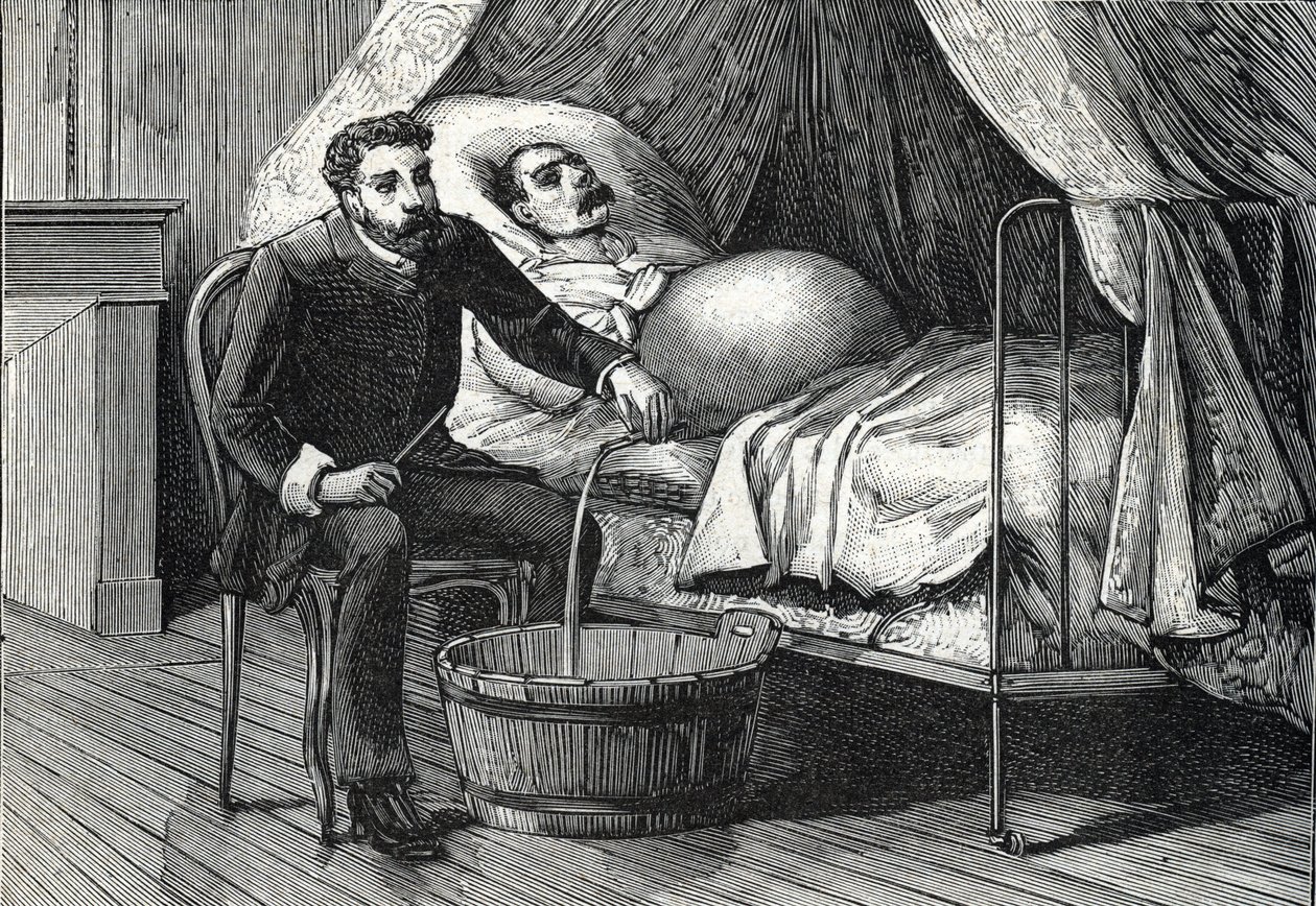 مريض بتليف كبدي متقدم ، طبيب يقوم بعمل ثقب (نقش) 1888 بواسطة المدرسة الفرنسية