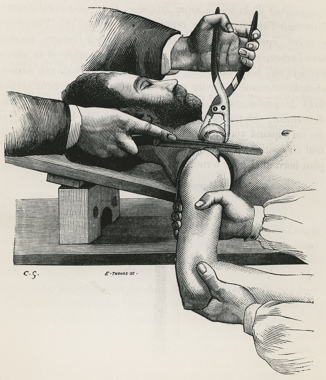 Resection of the shoulder, from 