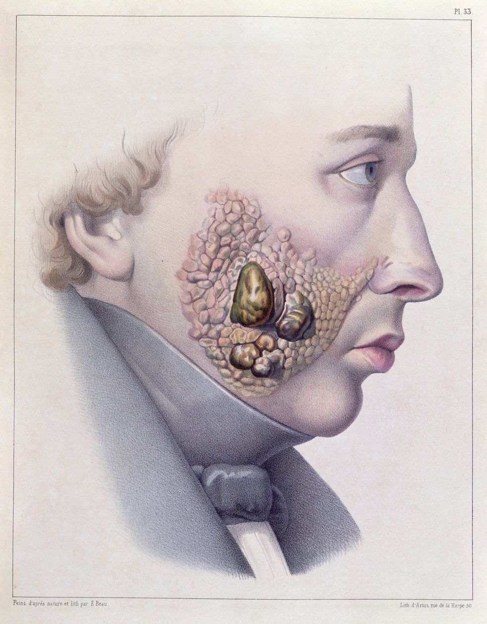 أعراض الوجه للأمراض التناسلية ، من Traite Complet des Maladies Veneriennes بواسطة فيليب ريكورد (1800-89) 1851 بواسطة المدرسة الفرنسية
