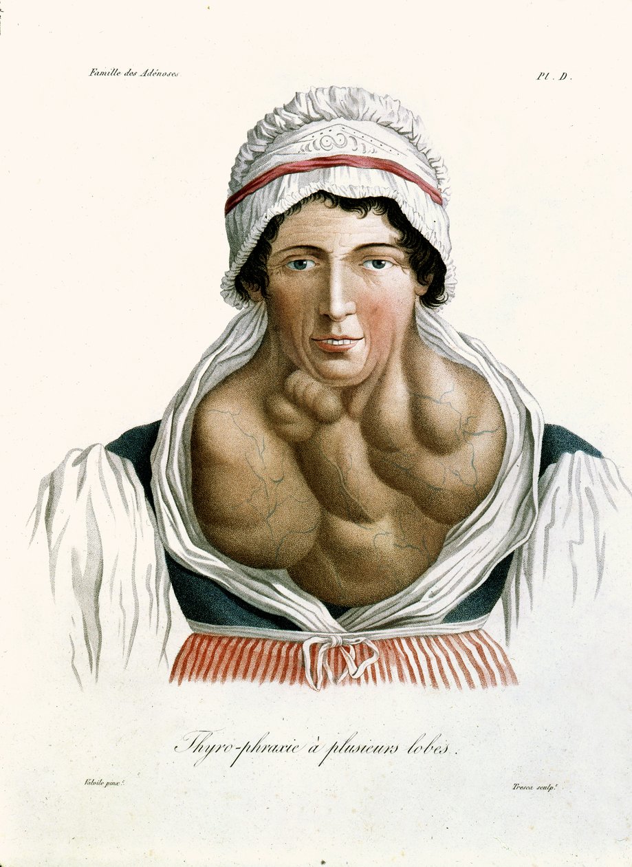 مرض الغدة الدرقية ، من كتاب البارون جان لويس عليبرت (1768-1837) 1817 بواسطة المدرسة الفرنسية