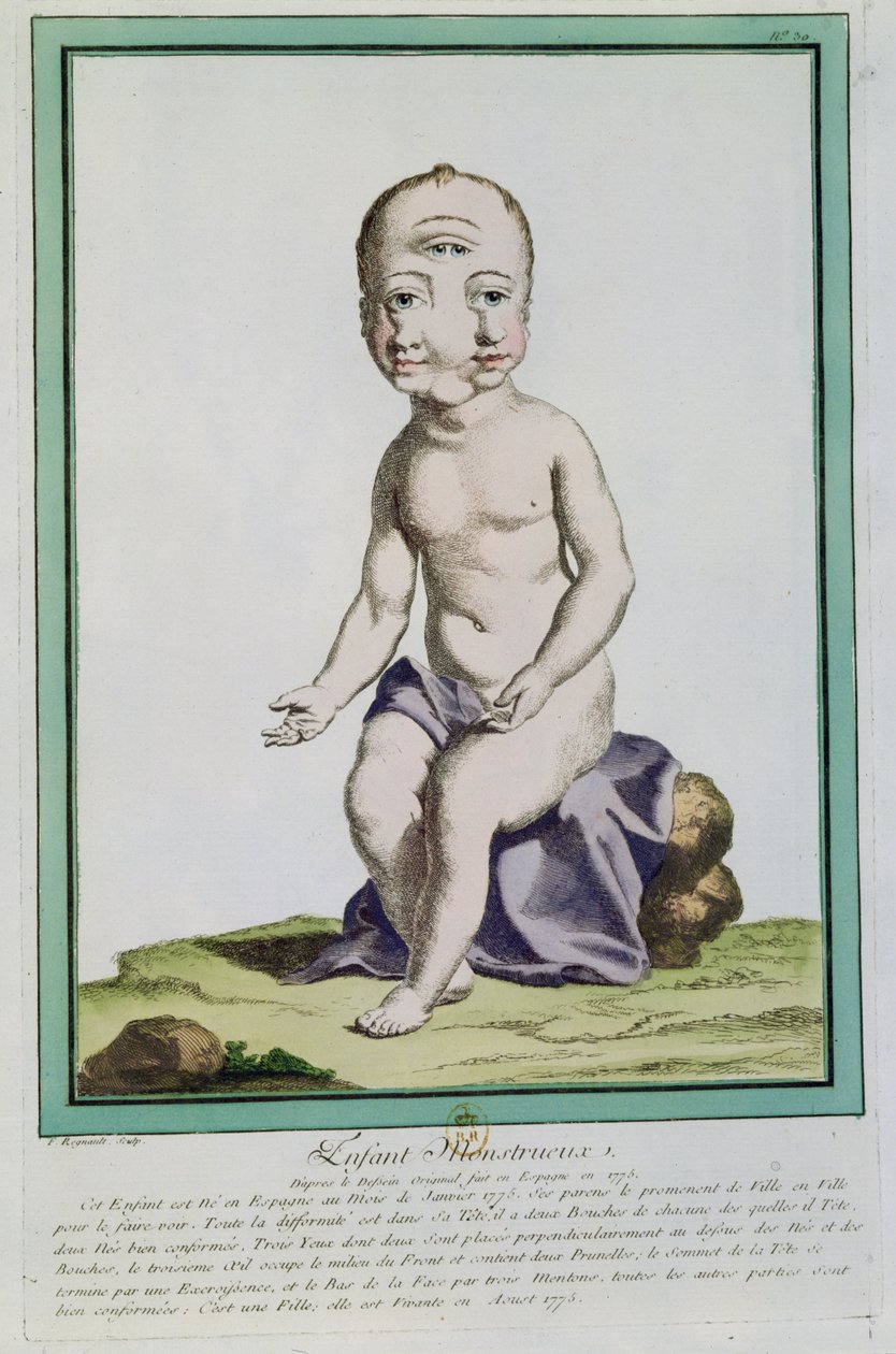 طفل ذو رأس مشوه ، من "Les Ecarts de la Nature" ، باريس ، 1775 بواسطة Genevieve Regnault de Nangis