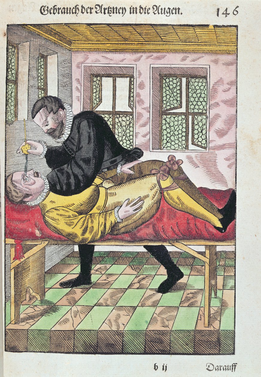 عملية العين ، من Ophthalmodouleia بواسطة جورج بارتيش (1535-1636) المنشورة في دريسدن في 1583 (طباعة لوحة خشبية ملونة) بواسطة المدرسة الألمانية