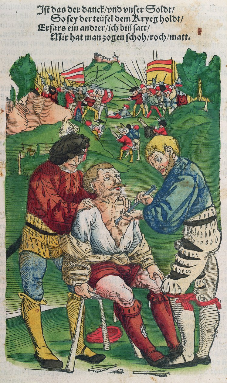 إزالة سهم ، رسم توضيحي من Feldtbuch der Wundartzney بواسطة Hans von Gersdorff ، 1540 بواسطة المدرسة الألمانية