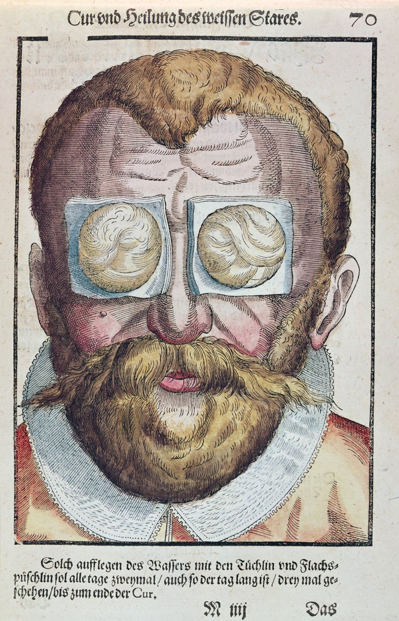 علاج حالة العين ، من طب العيون من قبل جورج بارتيش (1535-1636) المنشور في دريسدن عام 1583 (طبعة خشبية ملونة) بواسطة المدرسة الألمانية