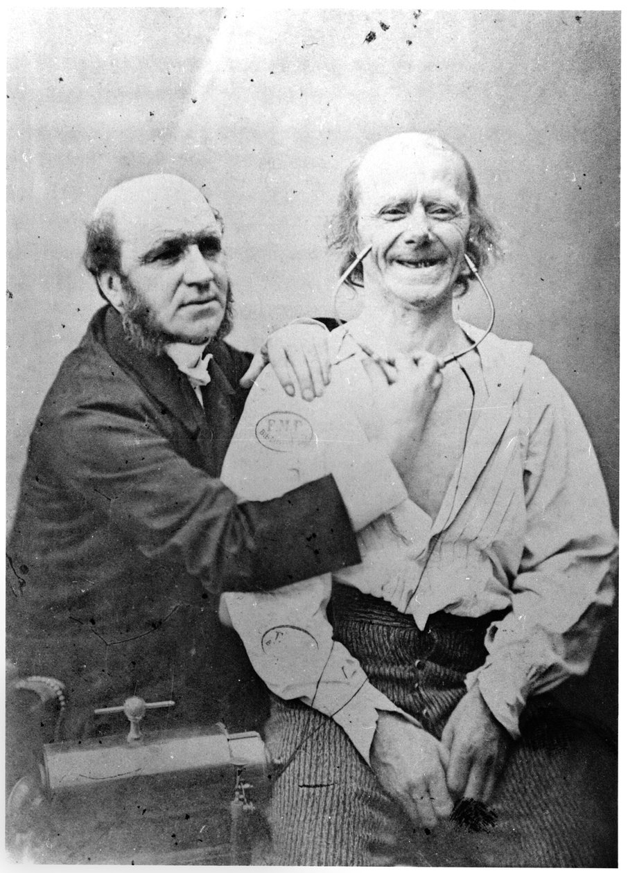 Faradisation للجبهة الأمامية ، من "Mecanisme de la physiognomie humaine ou تحليل Electrophysiologique des loveions" بواسطة Duchenne de Boulogne ، المنشور عام 1876 ، باريس بواسطة Guillaume Benjamin Armand Duchenne de Boulogne