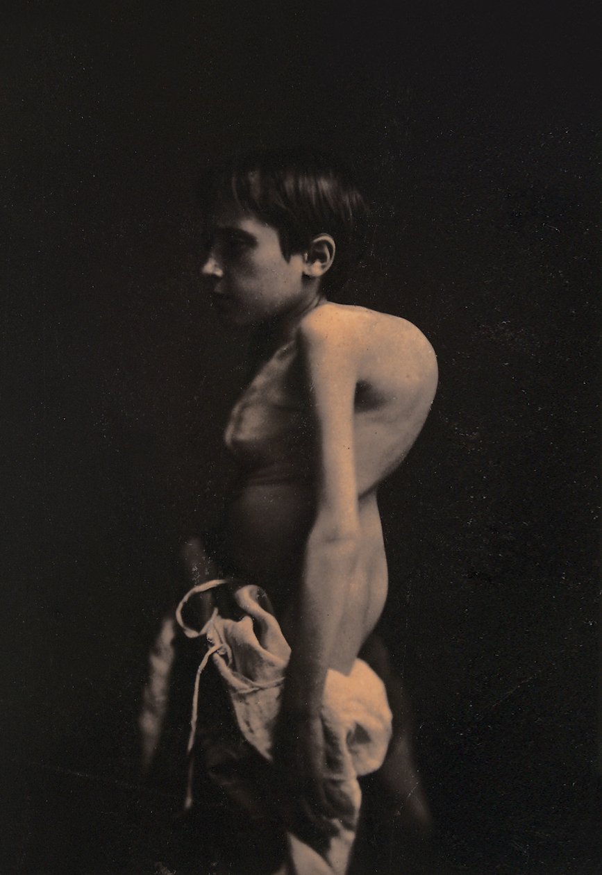 صورة لصبي الحدباء ، 1855-57 بواسطة Guillaume Benjamin Armand Duchenne de Boulogne