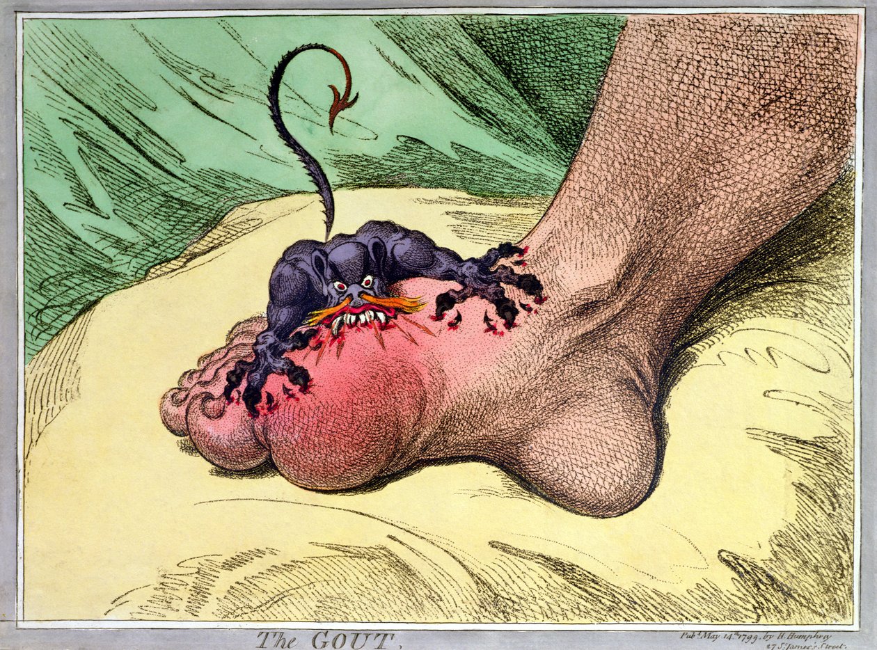 النقرس ، نشرته هانا همفري عام 1799 (نقش أرضي ملون يدويًا) بواسطة جيمس جيلراي