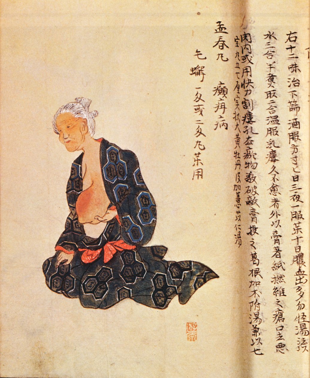 أول علاج جراحي لسرطان الثدي يتم تحت التخدير العام بواسطة Seishu Hanaoka (1760-1836) عام 1804 بواسطة المدرسة اليابانية