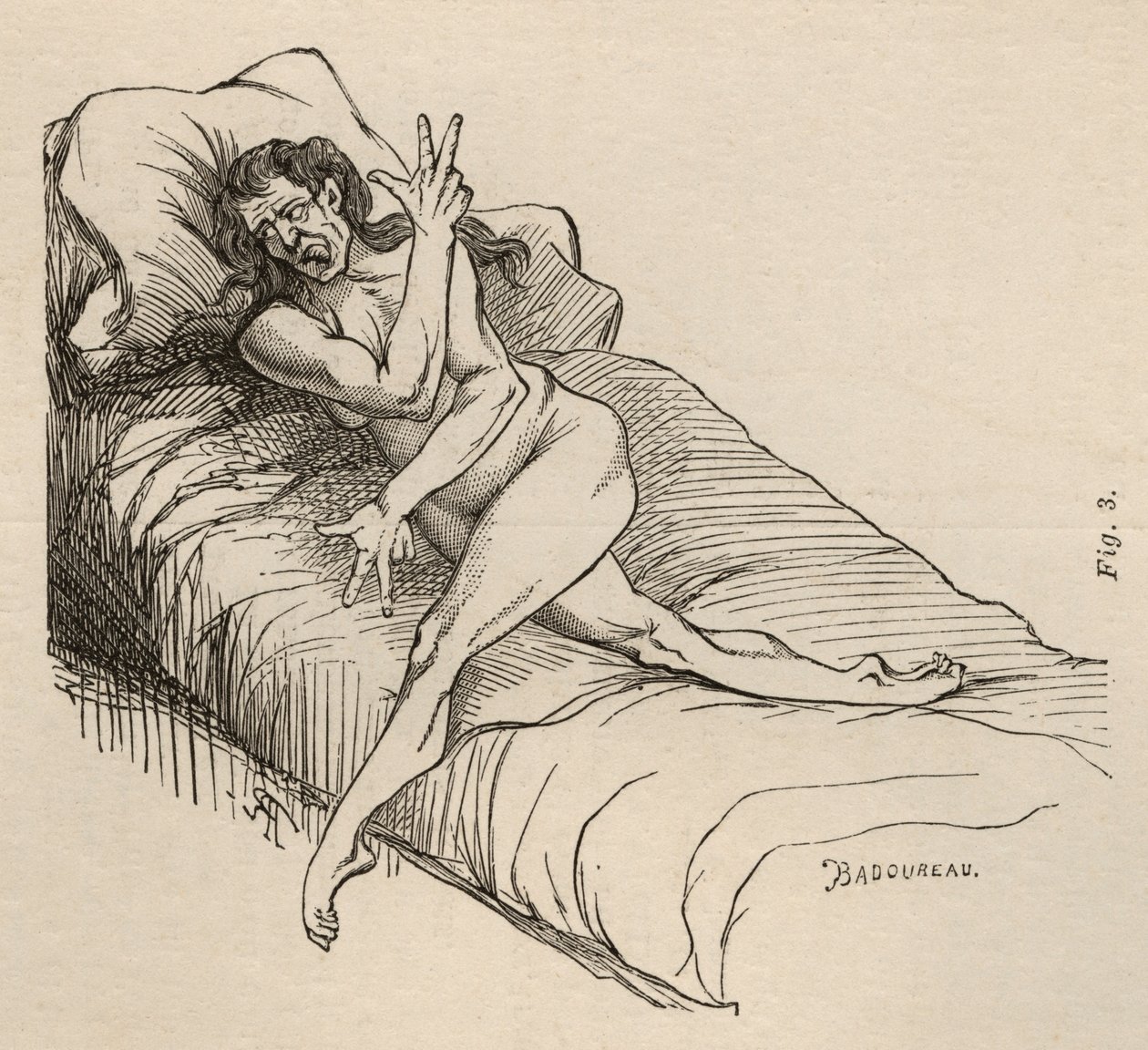 الصرع الهستيري ، الهجوم ، الالتواءات ، التين. 3 من "Iconographie Photographique de La Salpetriere" لبورنفيل وبي. ريجنارد ، باريس ، 1876 بواسطة جان فرانسوا بادورو