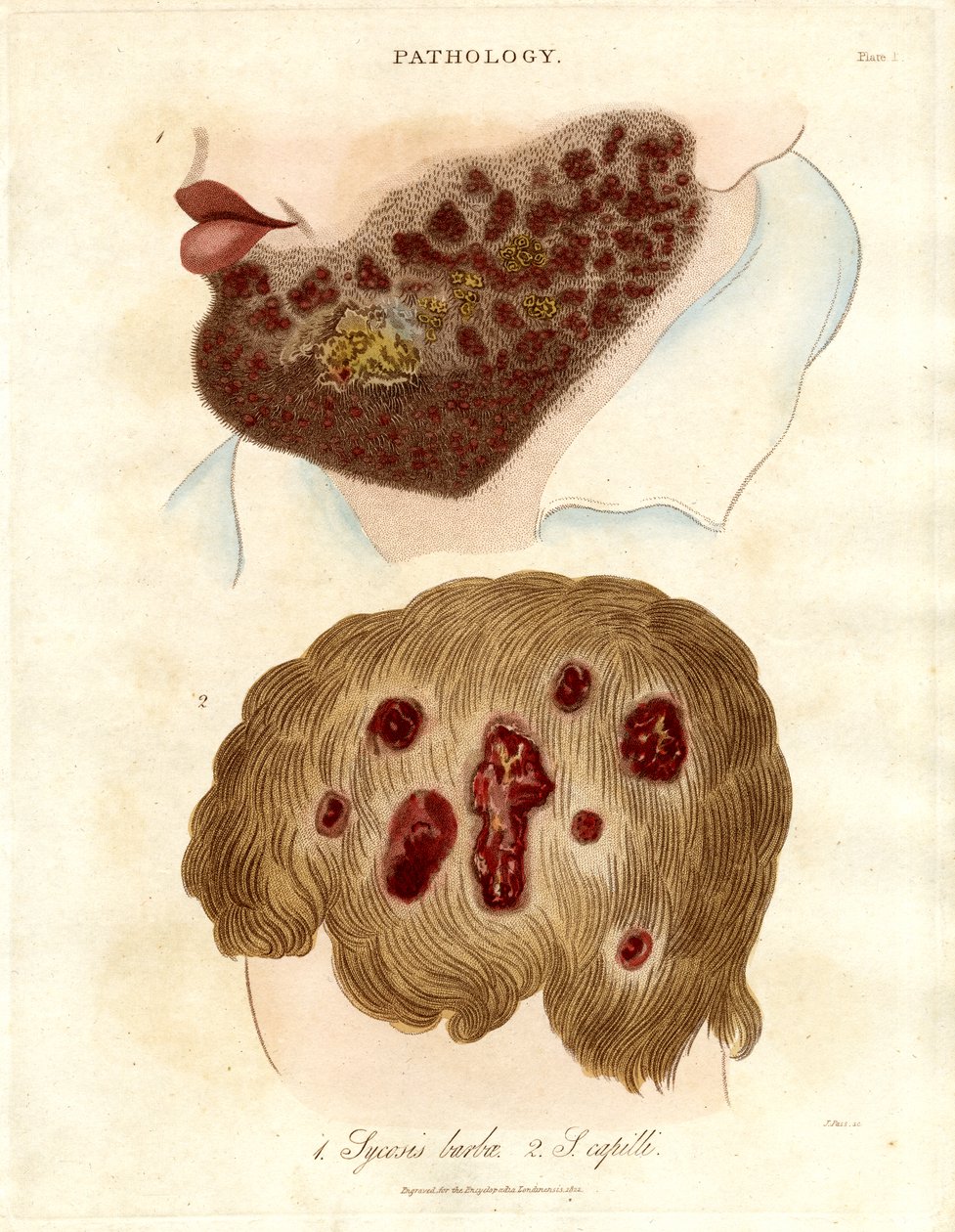 الرسم التوضيحي الباثولوجي لداء الزُّحار البربري وداء الزُّحار الشّعري بواسطة جون باس
