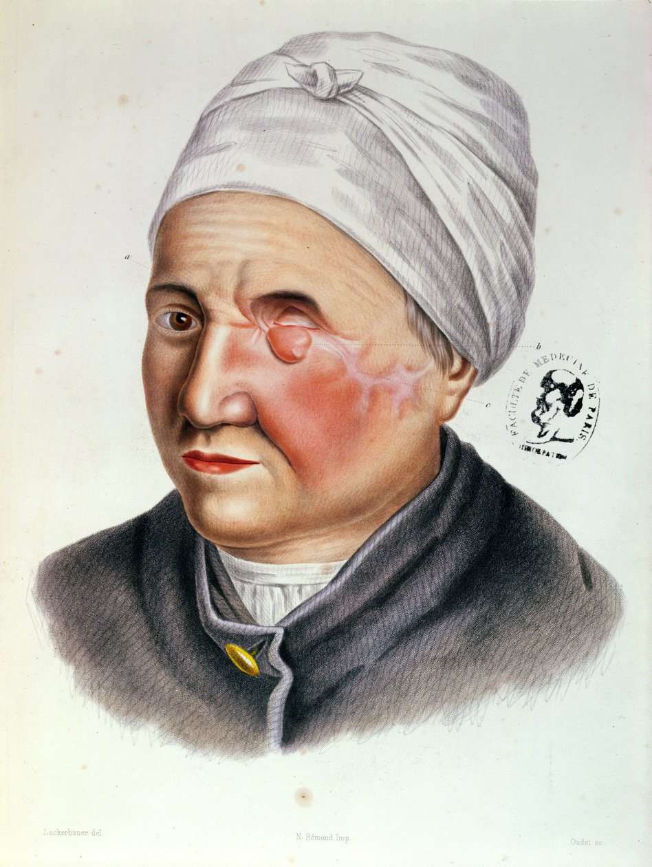 رسم توضيحي من Traite de Chirurgie Plastique بواسطة Antoine Jobert de Lamballe (1799-1867) باريس ، 1849 بواسطة باني رسام