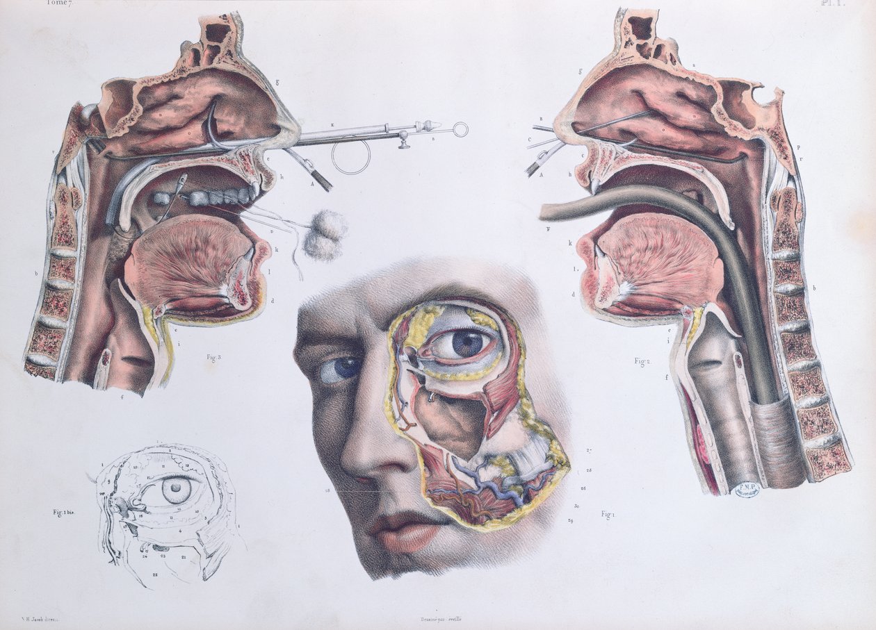 عملية الأنف ، صفيحة من "Traite Complet de l&39;Anatomie de l&39;Homme" بواسطة جان بابتيست مارك بورجري (1797-1849) 1866-67 بواسطة نيكولا هنري جاكوب