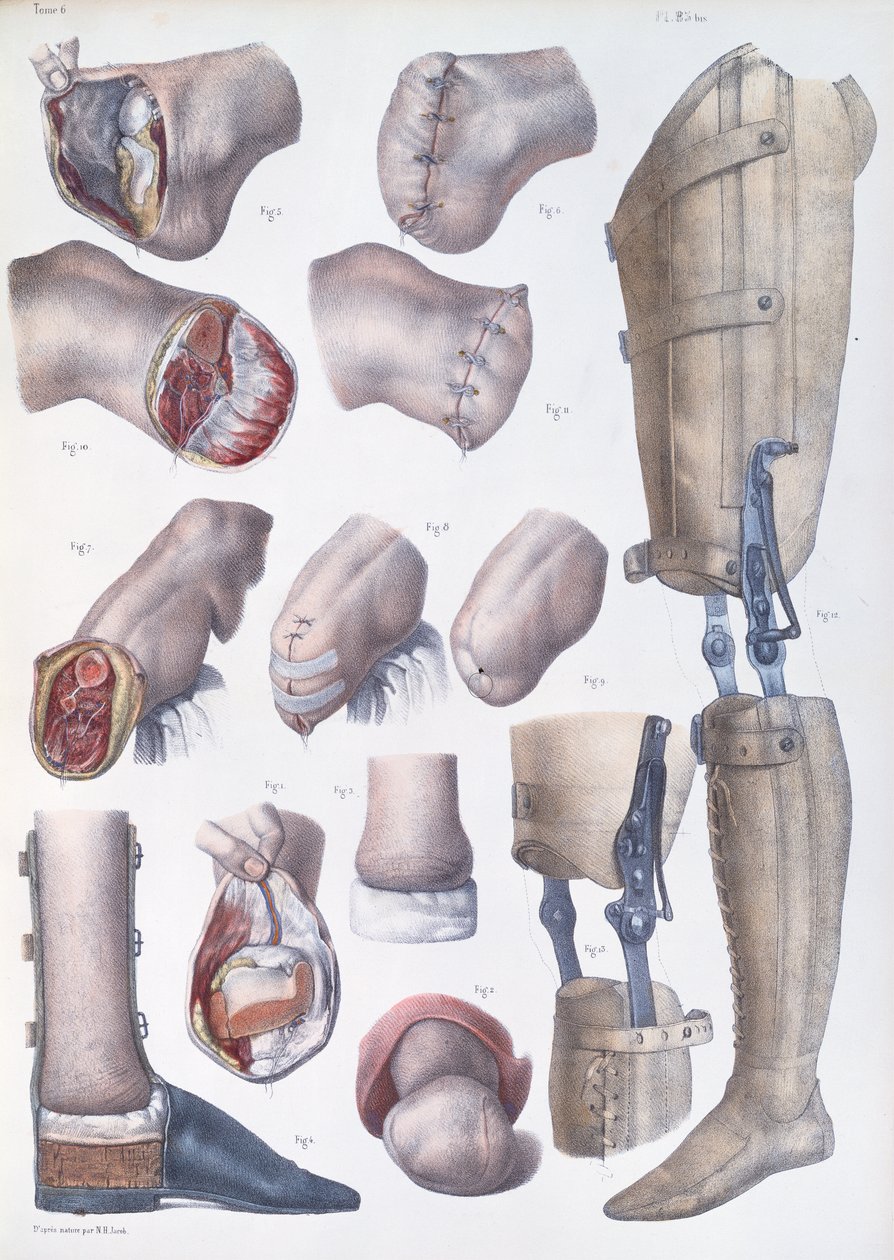 بتر الأطراف والأطراف الصناعية ، لوحة من "Traite Complet de l&39;Anatomie de l&39;Homme" بقلم جان باتيست مارك بورجري (1797-1849) 1866-67 بواسطة نيكولا هنري جاكوب