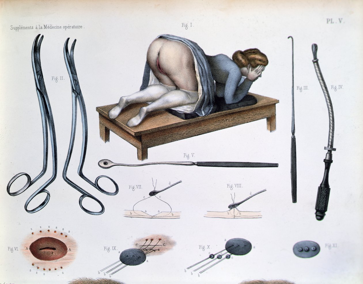 عملية جراحية للناسور المثاني المهبلي ، لوحة من "Traite Complet de l'Anatomie de l'Homme" بواسطة جان بابتيست مارك بورغيري (1797-1849) 1866-67 (نقش ملون) بواسطة نيكولا هنري جاكوب