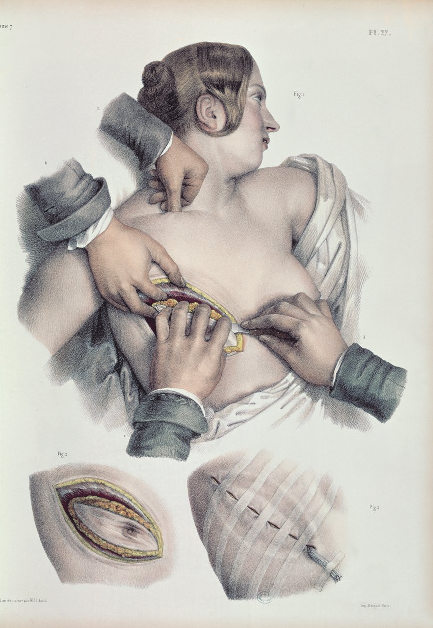 يعمل على ورم سرطاني ، من "Traite Complet de l&39;Anatomie de l&39;Homme" بواسطة جان بابتيست مارك بورجري (1797-1849) 1866-67 بواسطة نيكولا هنري جاكوب