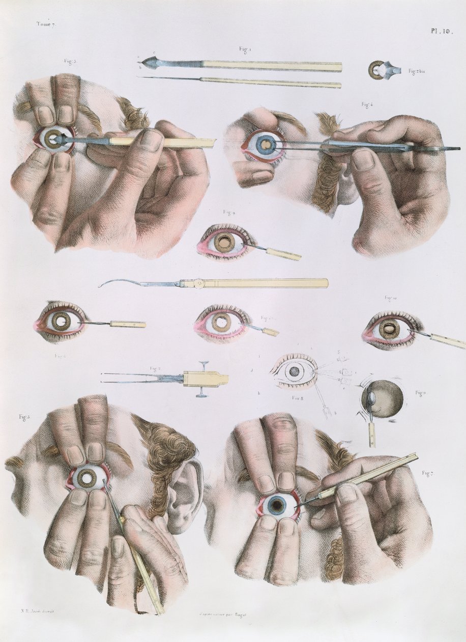 عملية على العين ، صفيحة من "Traite Complet de l&39;Anatomie de l&39;Homme" لجان بابتيست مارك بورجري (1797-1849) 1866-67 بواسطة نيكولا هنري جاكوب