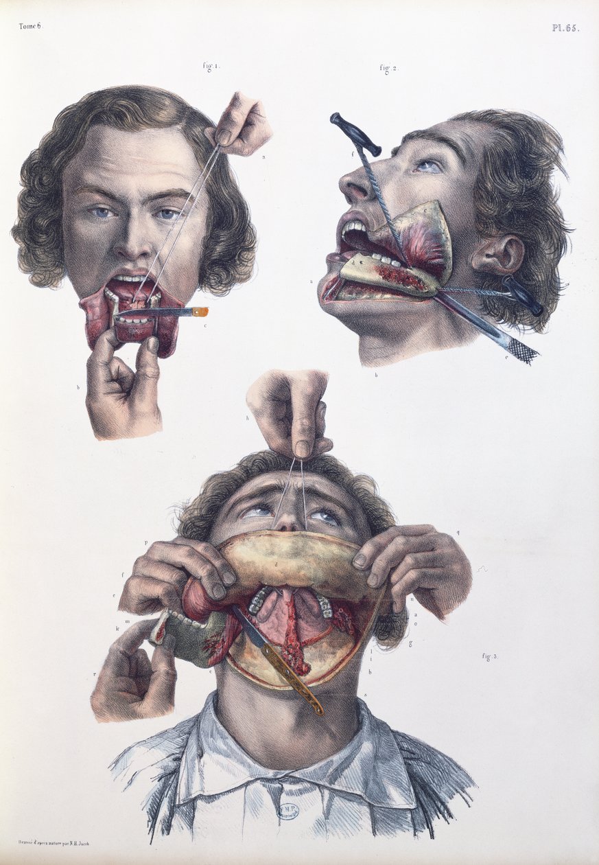 عملية على الفك السفلي ، صفيحة من "Traite Complet de l&39;Anatomie de l&39;Homme" لجان بابتيست مارك بورجري (1797-1849) 1866-67 بواسطة نيكولا هنري جاكوب