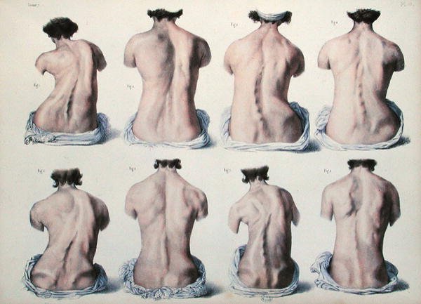 تشوهات العمود الفقري ، لوحة من "Traite Complet de l'Anatomie de l'Homme" بواسطة جان بابتيست مارك بورغيري (1797-1849) 1866-67 (نقش ملون) بواسطة نيكولا هنري جاكوب