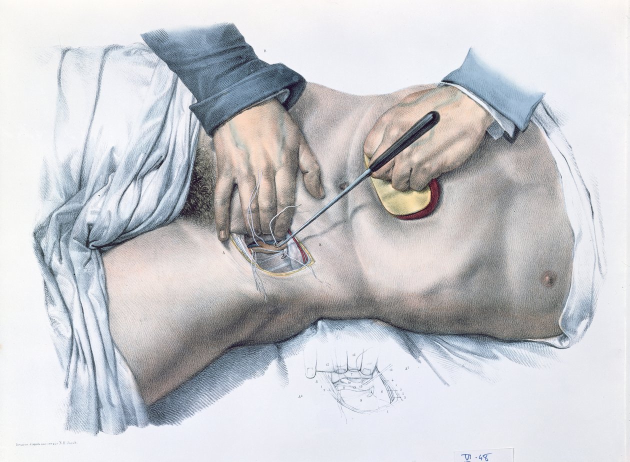 ربط شريان ، لوحة من "Traite Complet de l&39;Anatomie de l&39;Homme" بقلم جان بابتيست مارك بورجري (1797-1849) 1866-67 بواسطة نيكولا هنري جاكوب
